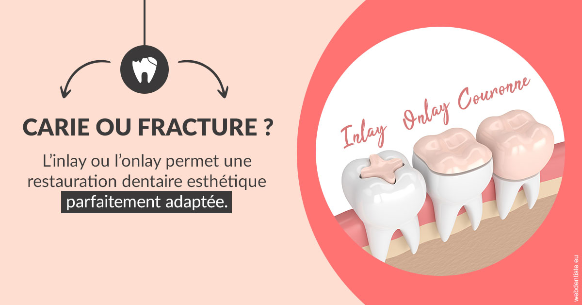 https://dr-attias-jacques.chirurgiens-dentistes.fr/T2 2023 - Carie ou fracture 2