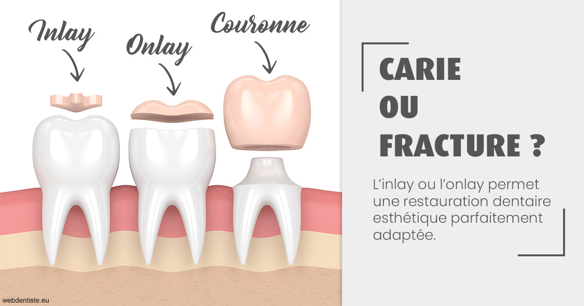 https://dr-attias-jacques.chirurgiens-dentistes.fr/T2 2023 - Carie ou fracture 1