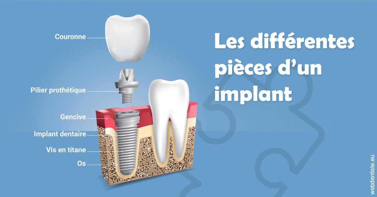 https://dr-attias-jacques.chirurgiens-dentistes.fr/Les différentes pièces d’un implant 1