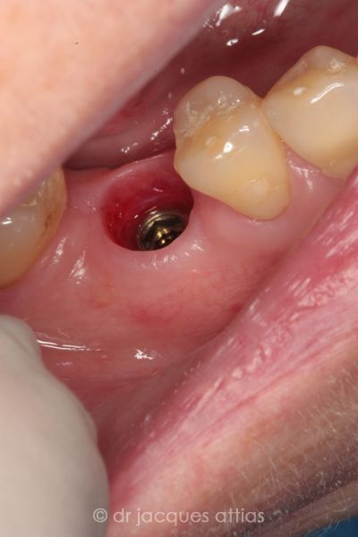 implant-dentiste-la-defense-10