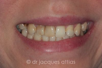 implant-dentiste-la-defense-08