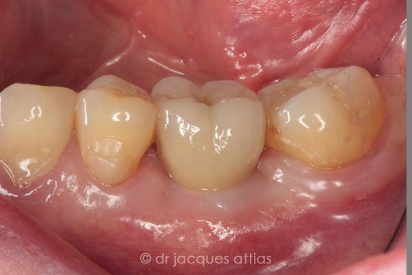 implant-dentiste-la-defense-13
