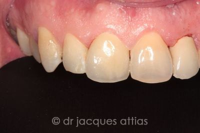 implant-dentiste-la-defense-05