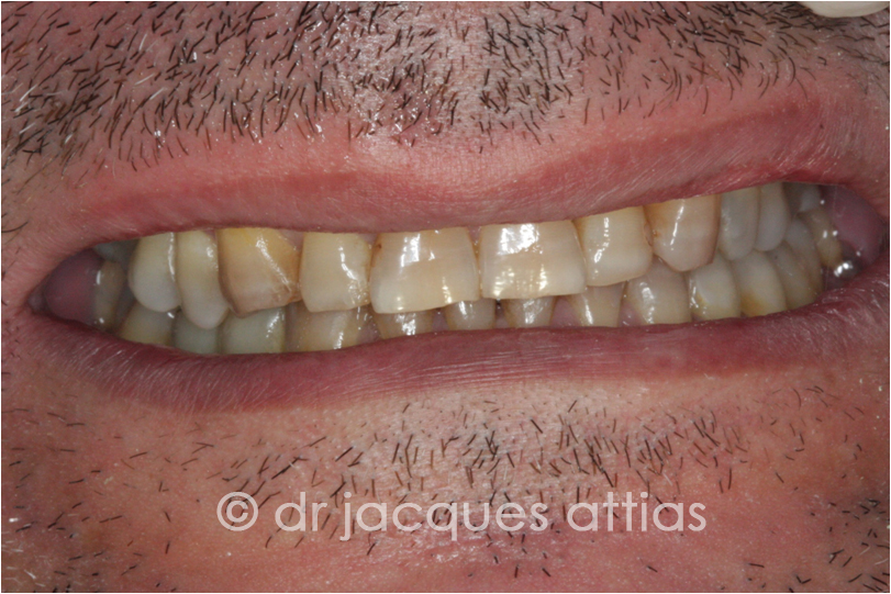 implant-dentiste-la-defense-09