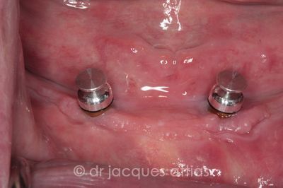 implant_dentiste_la_defense_2