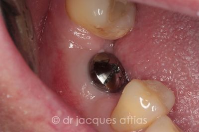 implant-dentiste-la-defense-11