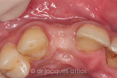 implant-dentiste-la-defense-14