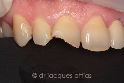 implant-dentiste-la-defense-04