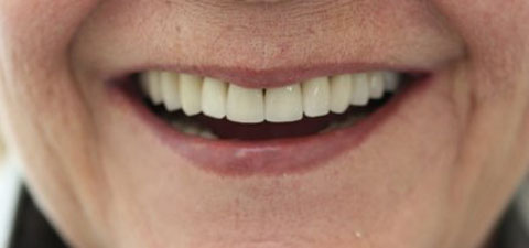 implant-dentaire-la-defense-3