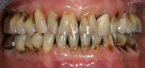 implant-dentaire-la-defense